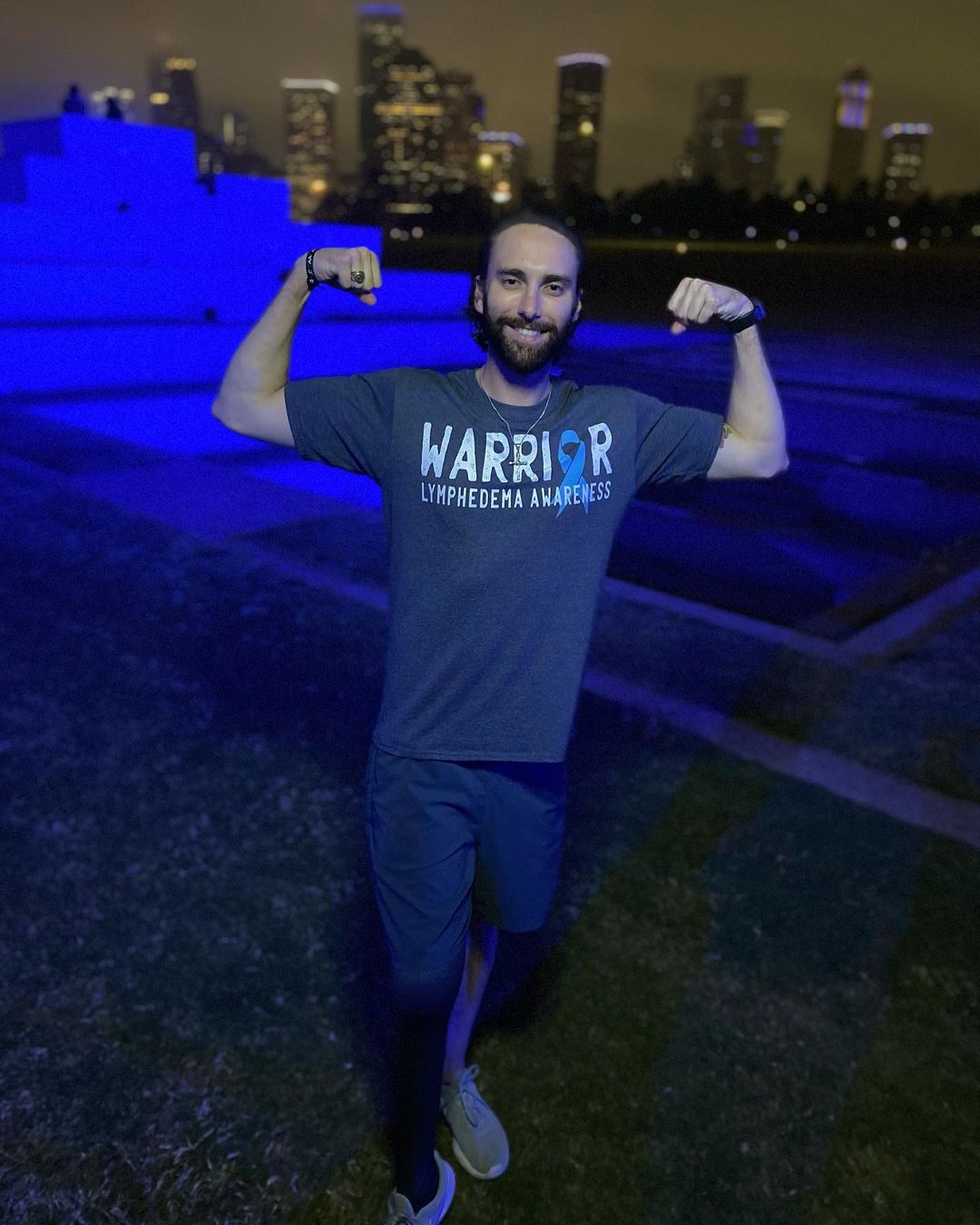 Cam Ayala suffered from a medical condition named lymphedema which led to leg amputation.
