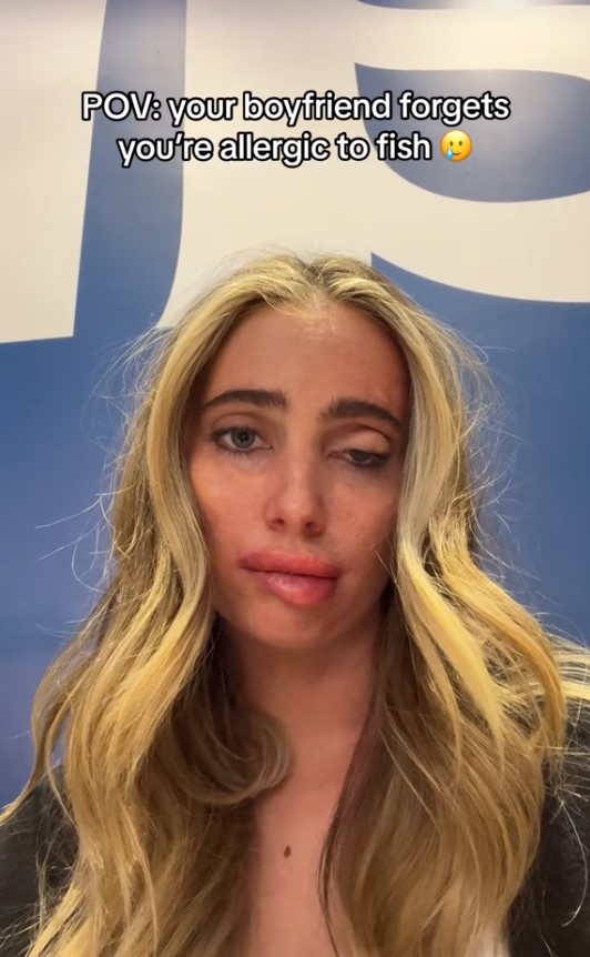 Lexi Hensler's face after the allergic reaction took place