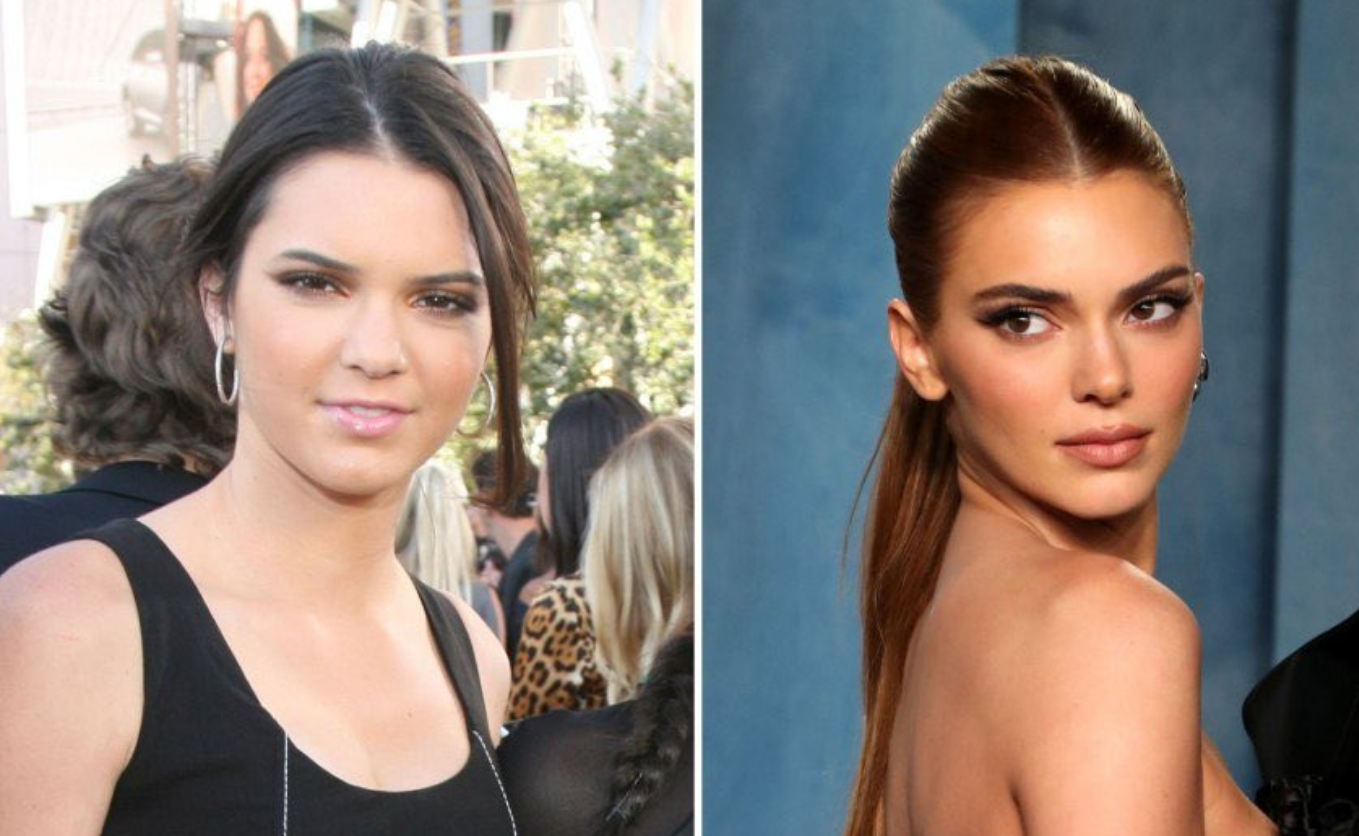 Kendall Jenner's nose looks refined and her lips look more plumed.