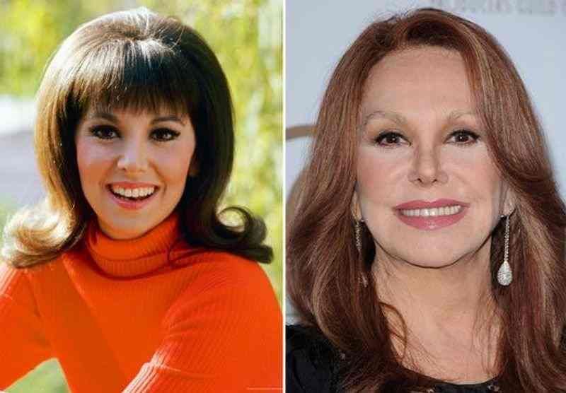 Marlo Thomas' before and after plastic surgery picture. 