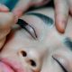 Top Considerations to Know Before Your Eyelid Surgery