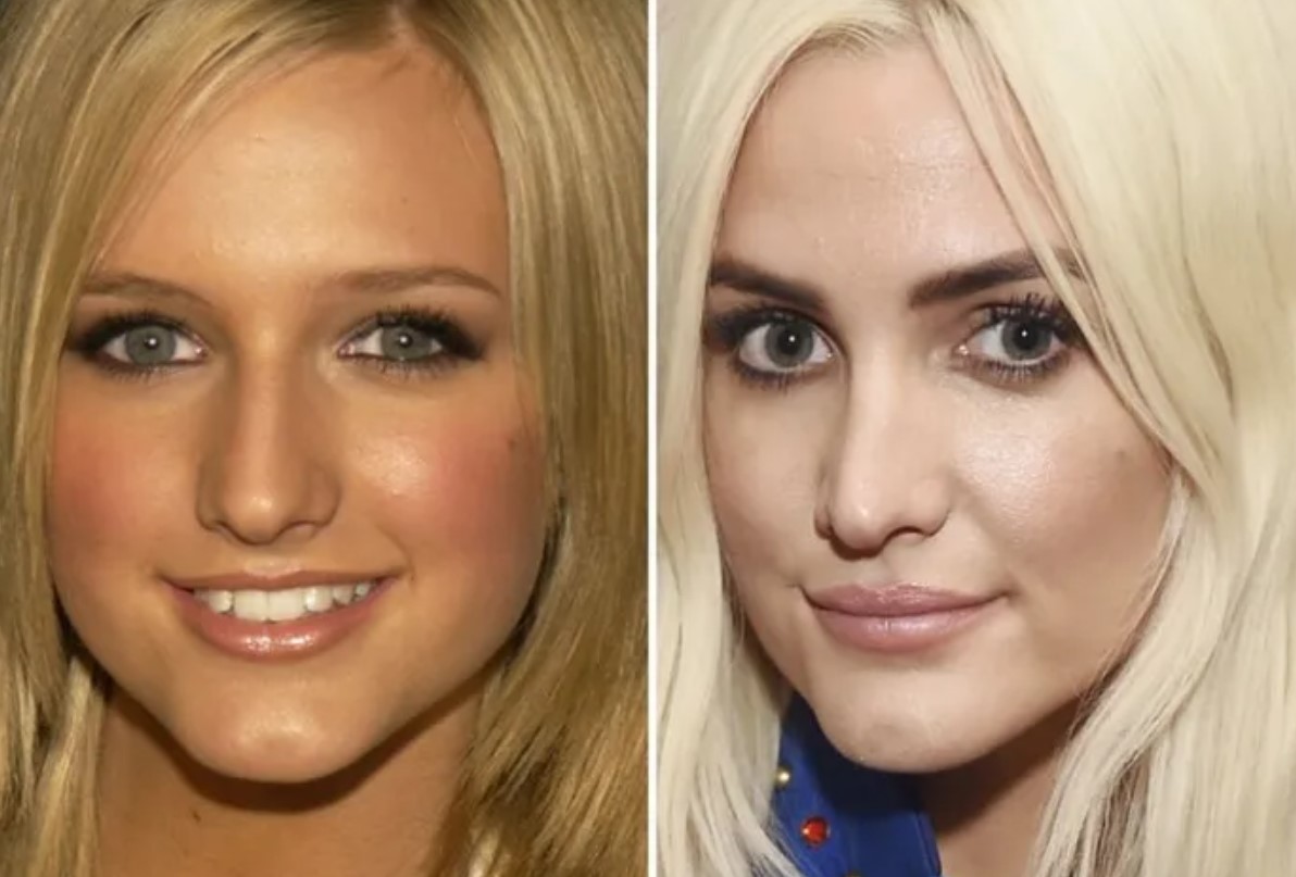 Ashlee Simpson before and after her alleged plastic surgery